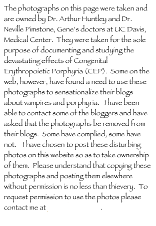 The photographs on this page were taken and are owned by Dr. Arthur Huntley and Dr. Neville Pimstone, Gene’s doctors at UC Davis, Medical Center.  They were taken for the sole purpose of documenting and studying the devastating effects of Congenital Erythropoietic Porphyria (CEP).  Some on the web, however, have found a need to use these photographs to sensationalize their blogs about vampires and porphyria.   I have been able to contact some of the bloggers and have asked that the photographs be removed from their blogs.  Some have complied, some have not.    I have chosen to post these disturbing photos on this website so as to take ownership of them.  Please understand that copying these photographs and posting them elsewhere without permission is no less than thievery.  To request permission to use the photos please contact me at genewb@cds1.net.
